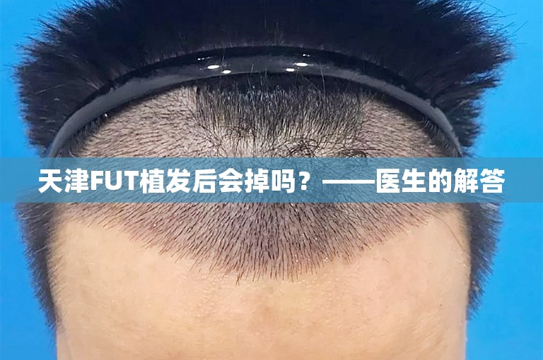 天津FUT植发后会掉吗？——医生的解答