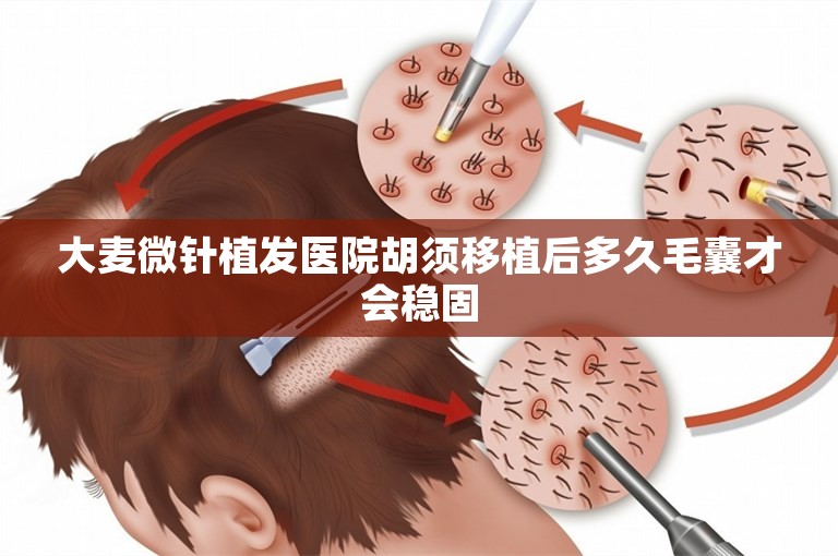 大麦微针植发医院胡须移植后多久毛囊才会稳固