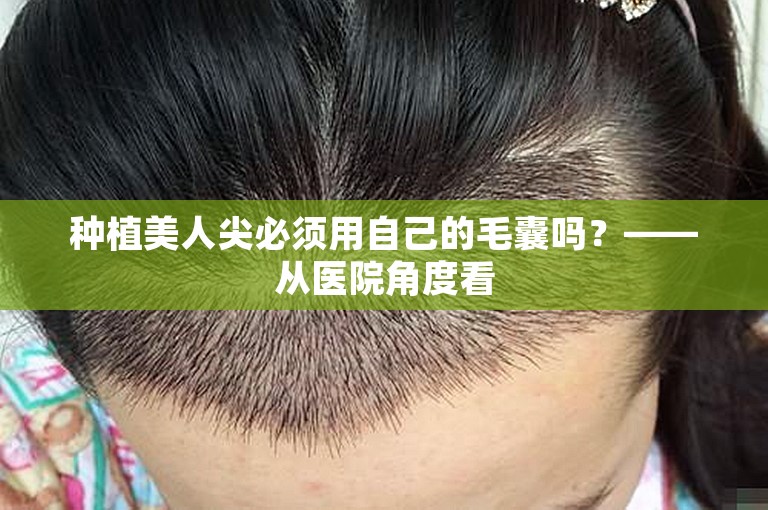 种植美人尖必须用自己的毛囊吗？——从医院角度看