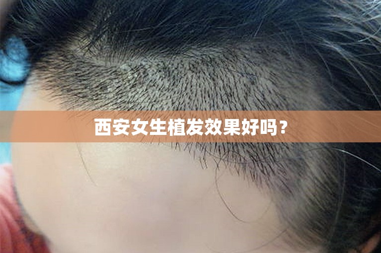 西安女生植发效果好吗？