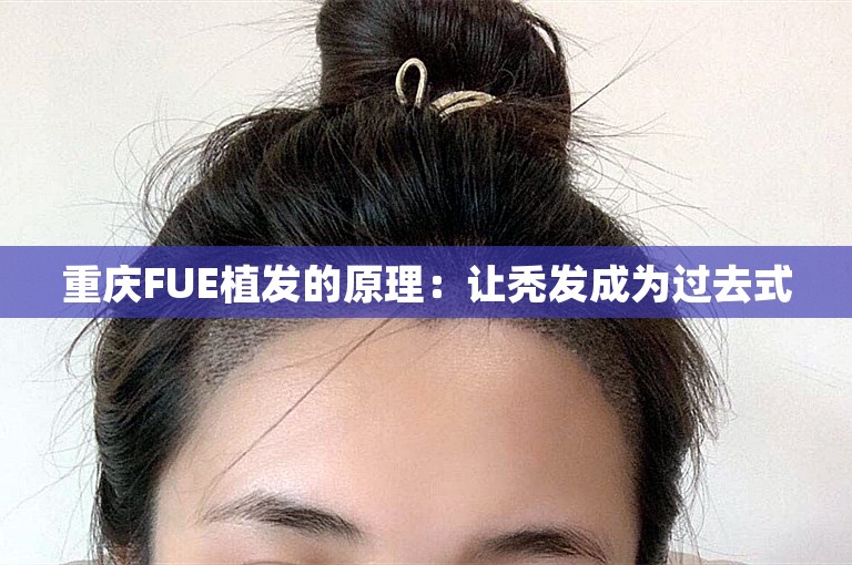 重庆FUE植发的原理：让秃发成为过去式