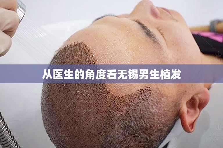 从医生的角度看无锡男生植发