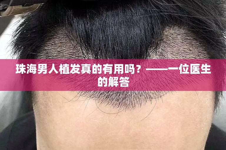 珠海男人植发真的有用吗？——一位医生的解答