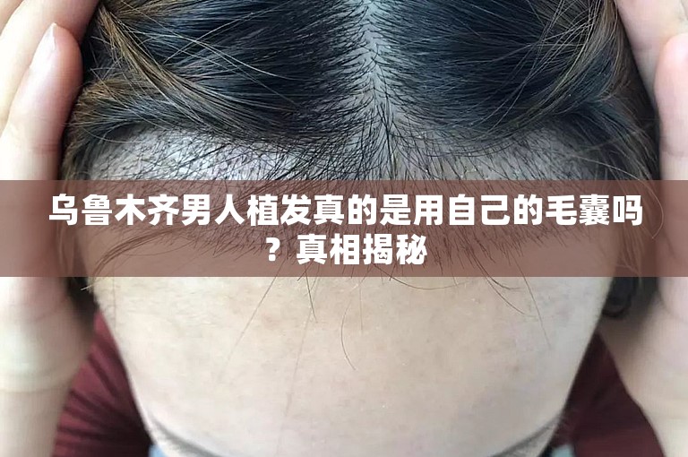 乌鲁木齐男人植发真的是用自己的毛囊吗？真相揭秘