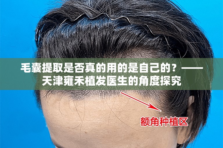 毛囊提取是否真的用的是自己的？——天津雍禾植发医生的角度探究