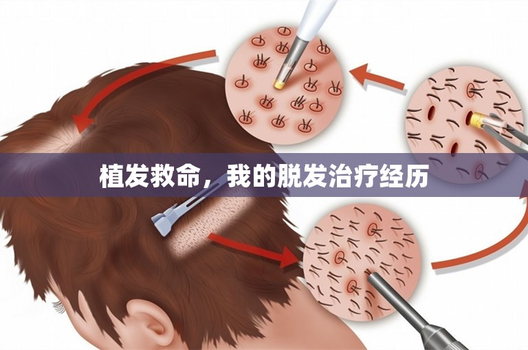 植发救命，我的脱发治疗经历