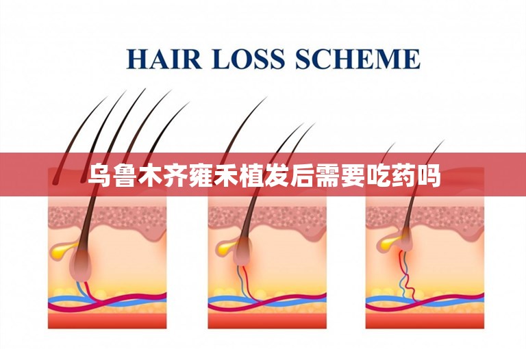 乌鲁木齐雍禾植发后需要吃药吗