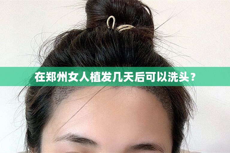 在郑州女人植发几天后可以洗头？