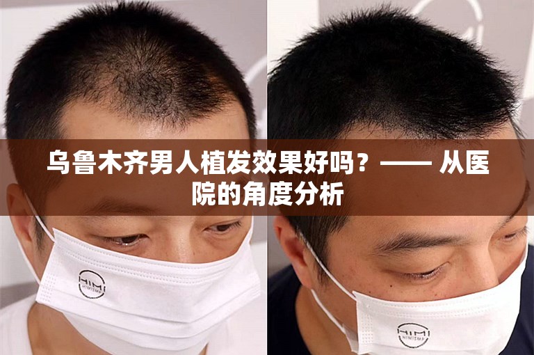 乌鲁木齐男人植发效果好吗？—— 从医院的角度分析