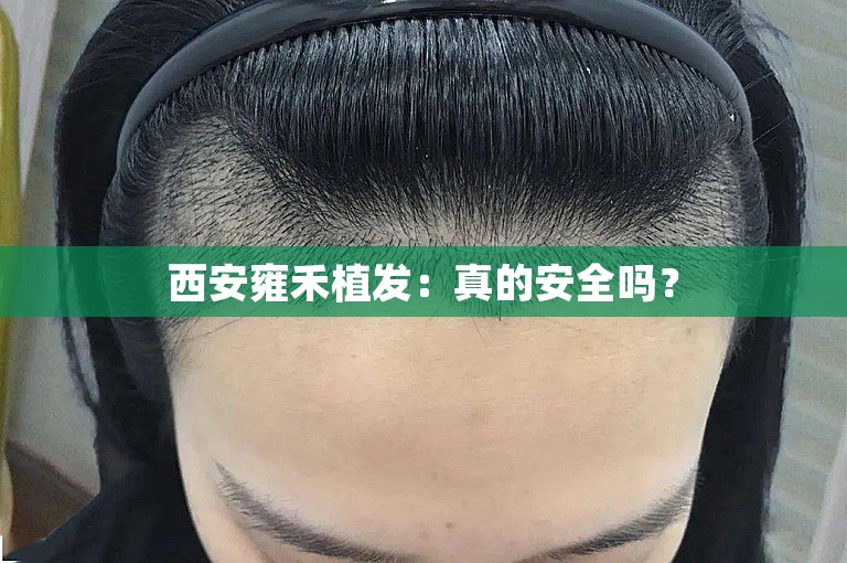 西安雍禾植发：真的安全吗？