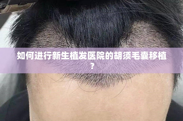 如何进行新生植发医院的胡须毛囊移植？