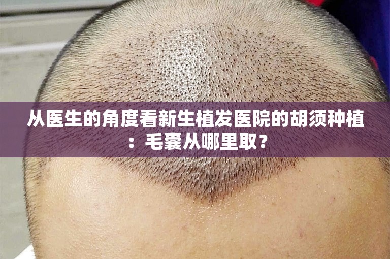 从医生的角度看新生植发医院的胡须种植：毛囊从哪里取？