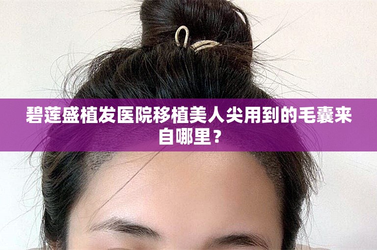 碧莲盛植发医院移植美人尖用到的毛囊来自哪里？