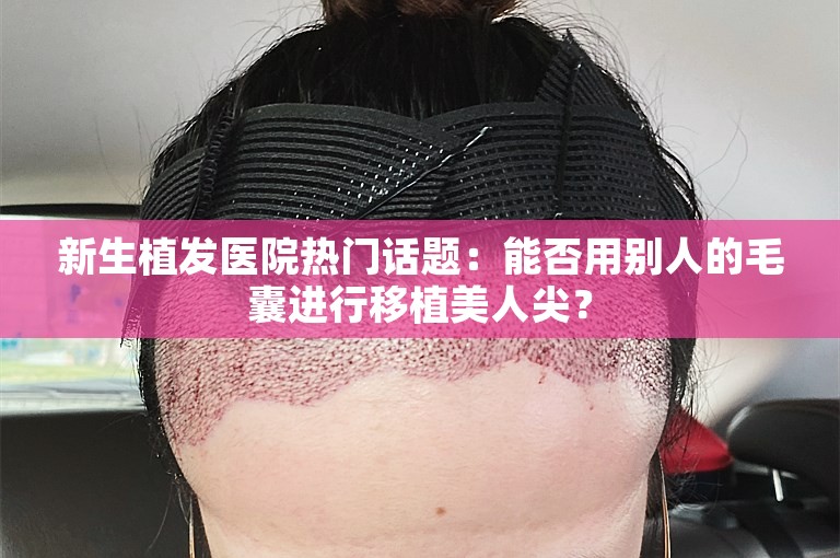 新生植发医院热门话题：能否用别人的毛囊进行移植美人尖？