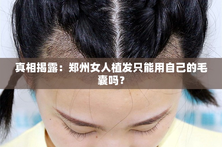 真相揭露：郑州女人植发只能用自己的毛囊吗？