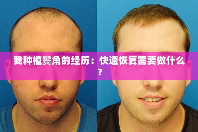 我种植鬓角的经历：快速恢复需要做什么？