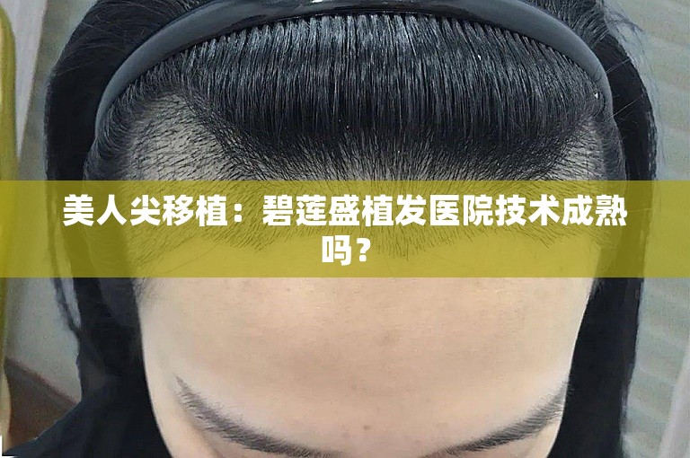 美人尖移植：碧莲盛植发医院技术成熟吗？