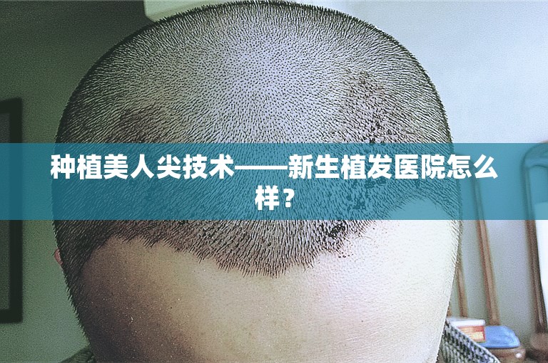 种植美人尖技术——新生植发医院怎么样？