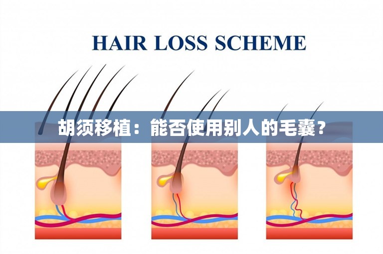 胡须移植：能否使用别人的毛囊？