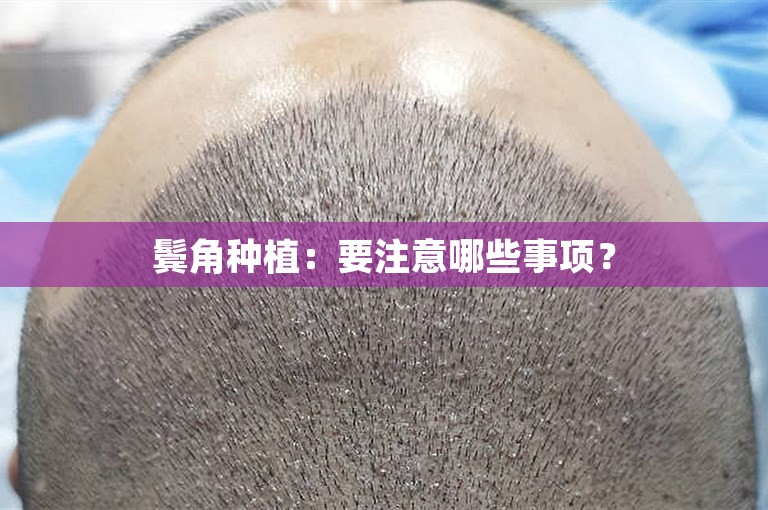 鬓角种植：要注意哪些事项？