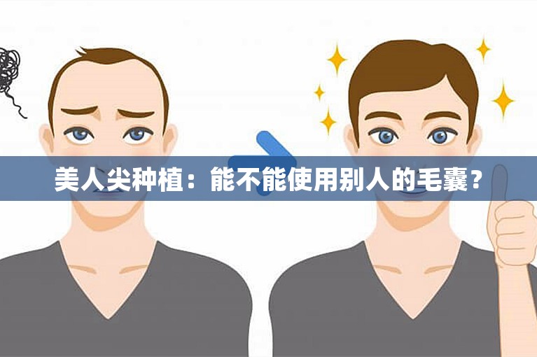 美人尖种植：能不能使用别人的毛囊？