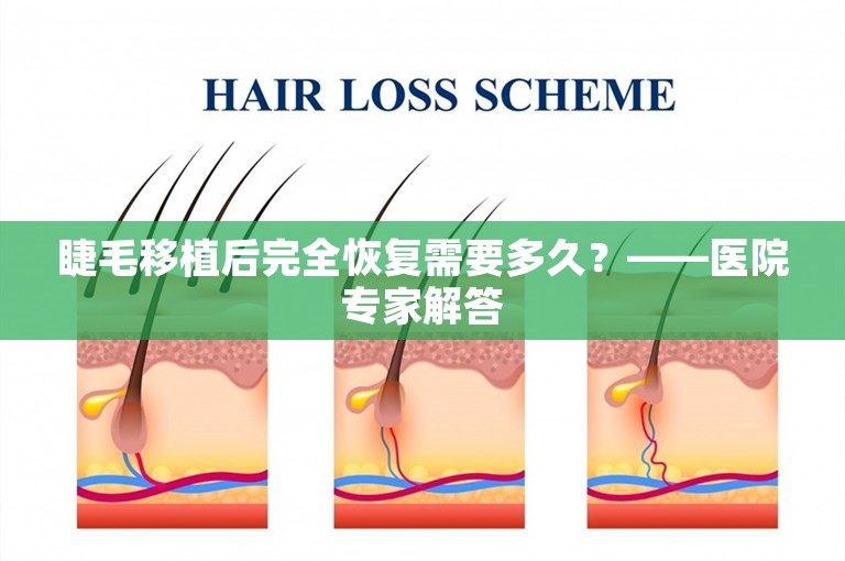 睫毛移植后完全恢复需要多久？——医院专家解答