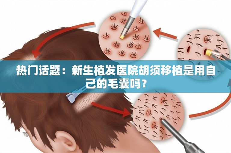 热门话题：新生植发医院胡须移植是用自己的毛囊吗？