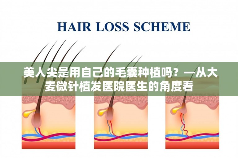  美人尖是用自己的毛囊种植吗？—从大麦微针植发医院医生的角度看