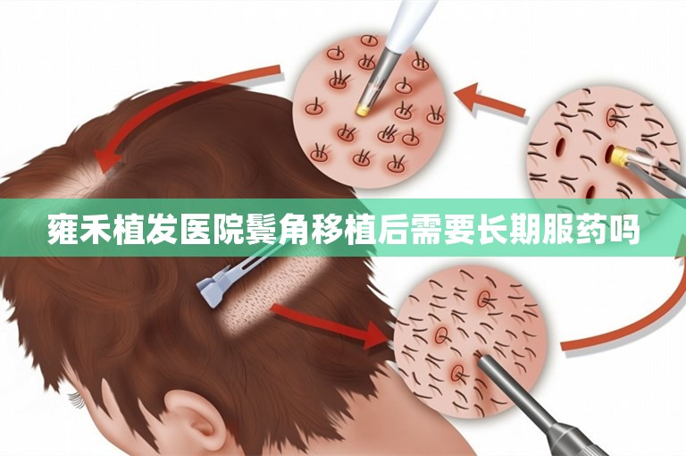 雍禾植发医院鬓角移植后需要长期服药吗