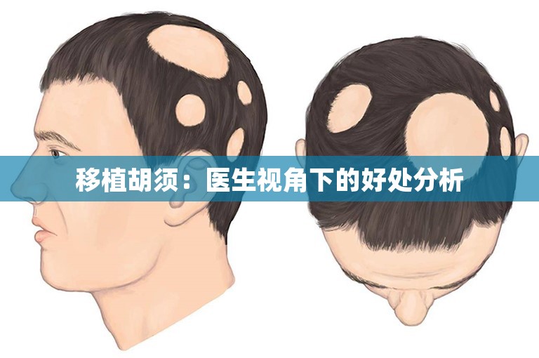 移植胡须：医生视角下的好处分析