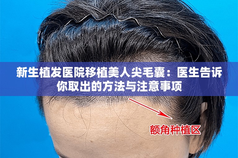 新生植发医院移植美人尖毛囊：医生告诉你取出的方法与注意事项