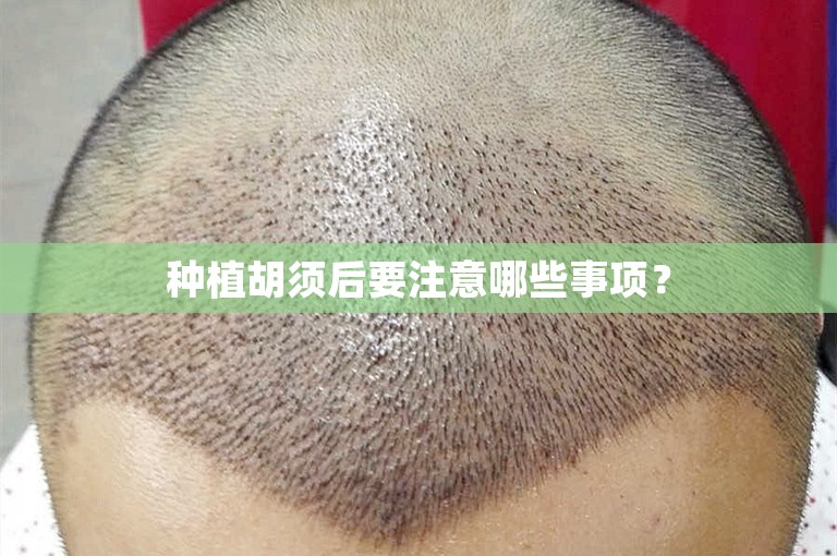 种植胡须后要注意哪些事项？