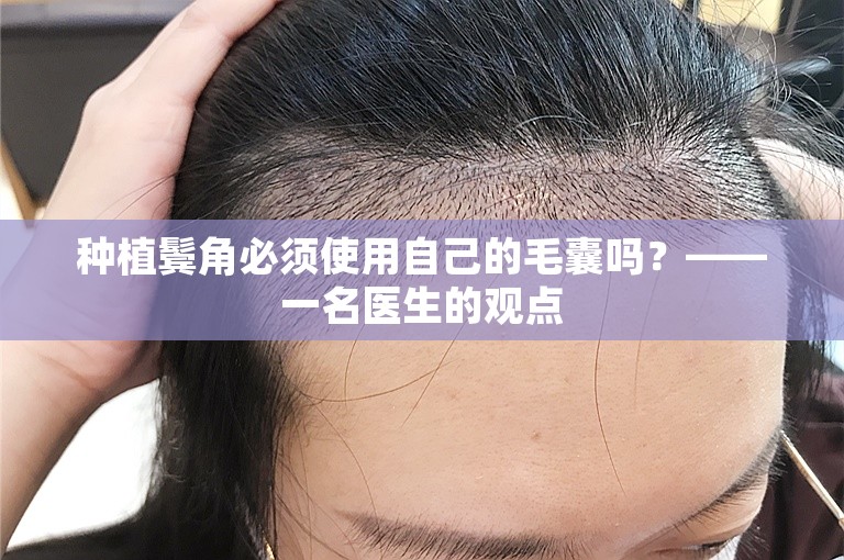 种植鬓角必须使用自己的毛囊吗？——一名医生的观点