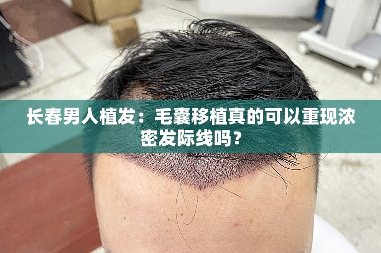 长春男人植发：毛囊移植真的可以重现浓密发际线吗？