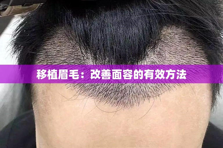 移植眉毛：改善面容的有效方法