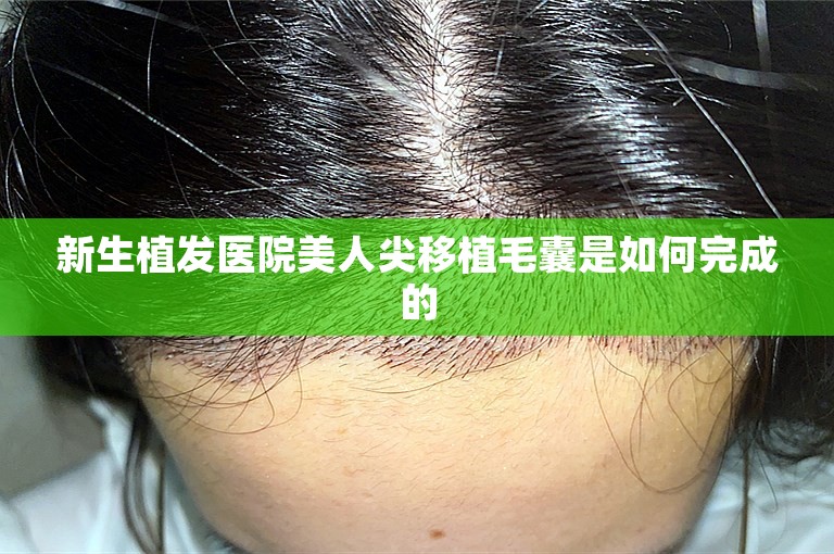 新生植发医院美人尖移植毛囊是如何完成的