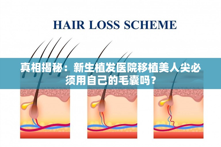 真相揭秘：新生植发医院移植美人尖必须用自己的毛囊吗？