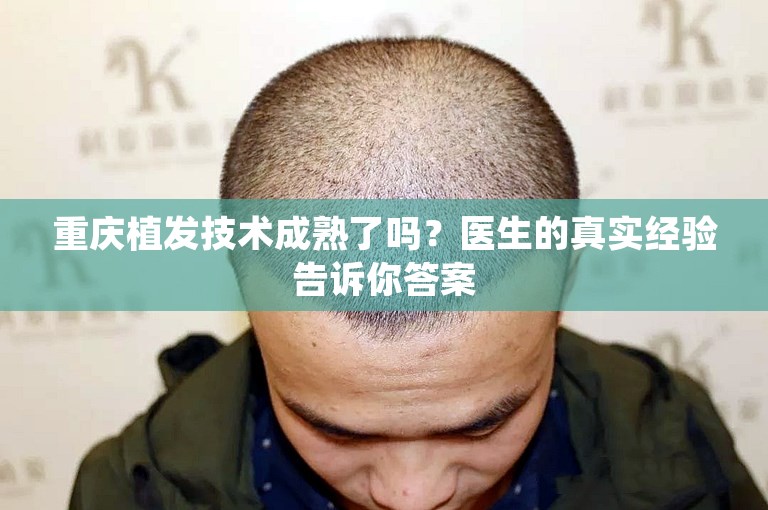 重庆植发技术成熟了吗？医生的真实经验告诉你答案