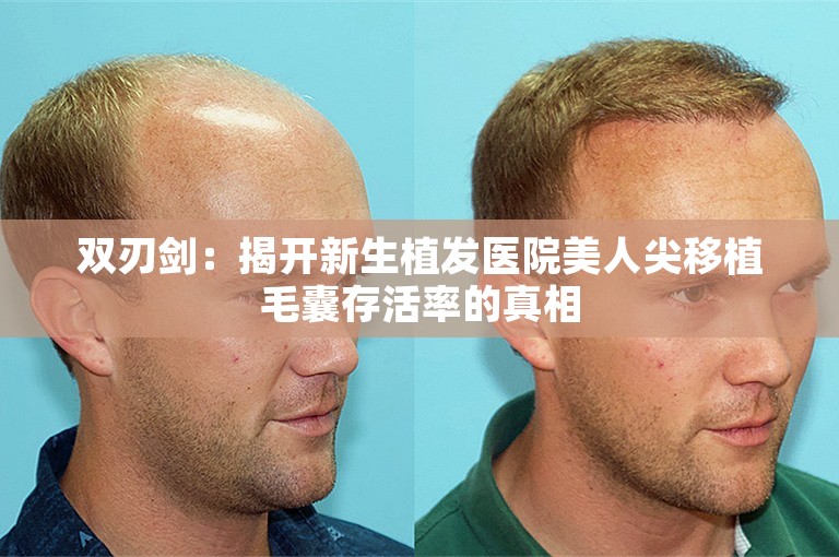 双刃剑：揭开新生植发医院美人尖移植毛囊存活率的真相