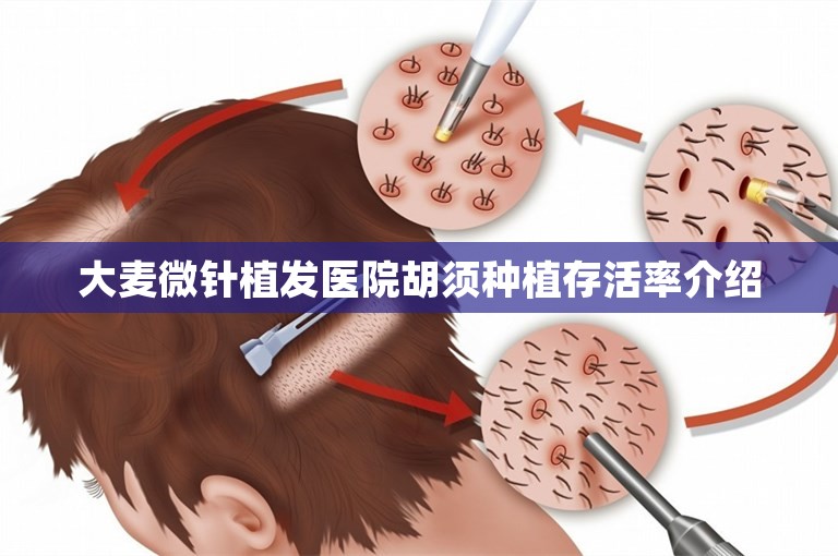 大麦微针植发医院胡须种植存活率介绍