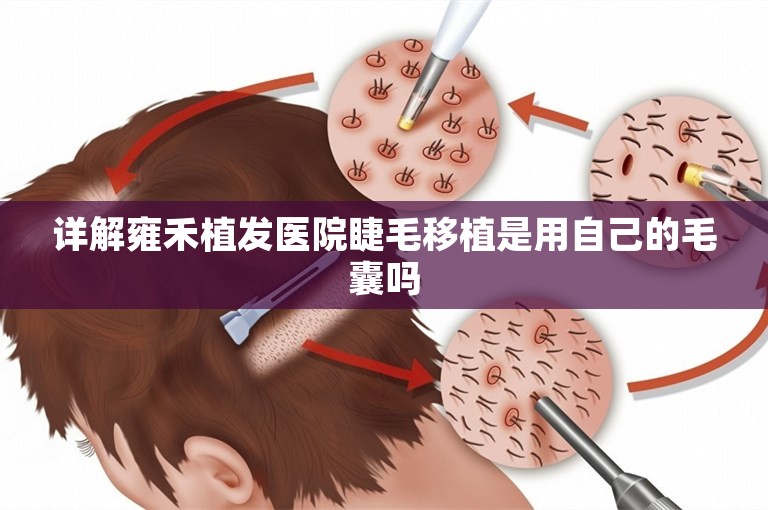 详解雍禾植发医院睫毛移植是用自己的毛囊吗