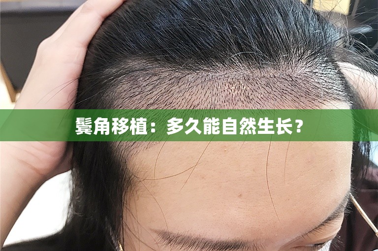 鬓角移植：多久能自然生长？