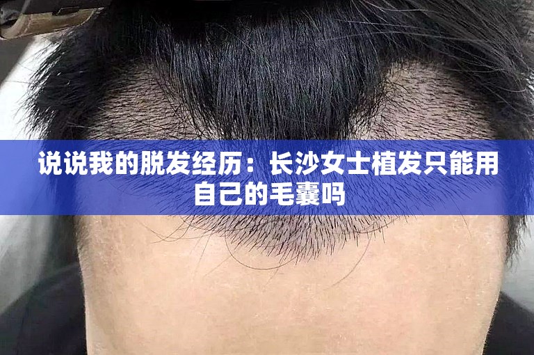 说说我的脱发经历：长沙女士植发只能用自己的毛囊吗