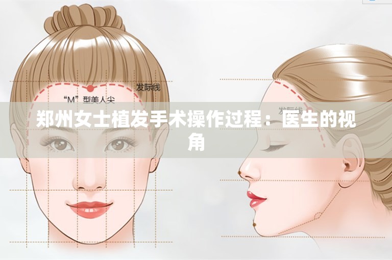 郑州女士植发手术操作过程：医生的视角