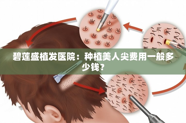 碧莲盛植发医院：种植美人尖费用一般多少钱？