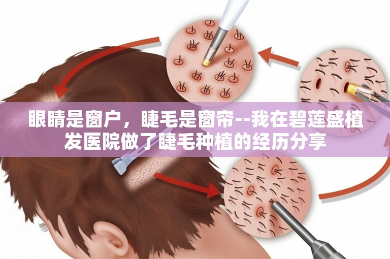 眼睛是窗户，睫毛是窗帘--我在碧莲盛植发医院做了睫毛种植的经历分享