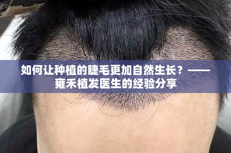 如何让种植的睫毛更加自然生长？——雍禾植发医生的经验分享