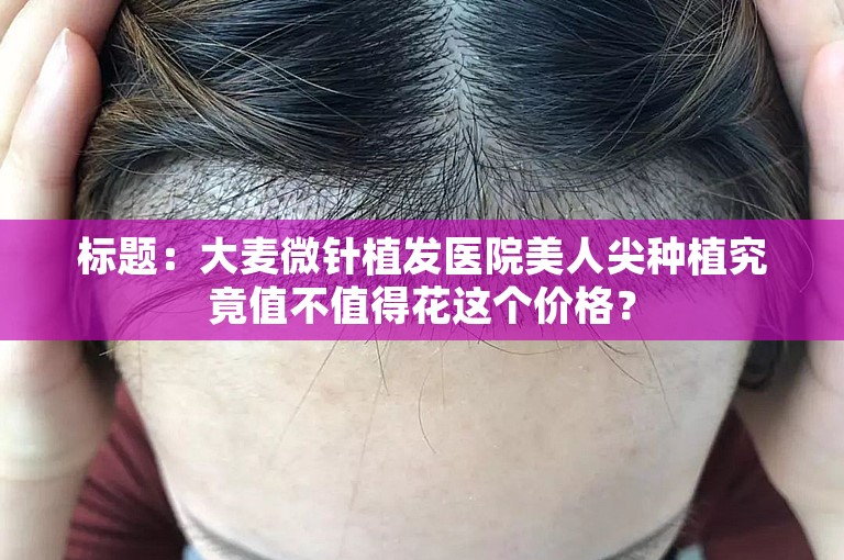 标题：大麦微针植发医院美人尖种植究竟值不值得花这个价格？