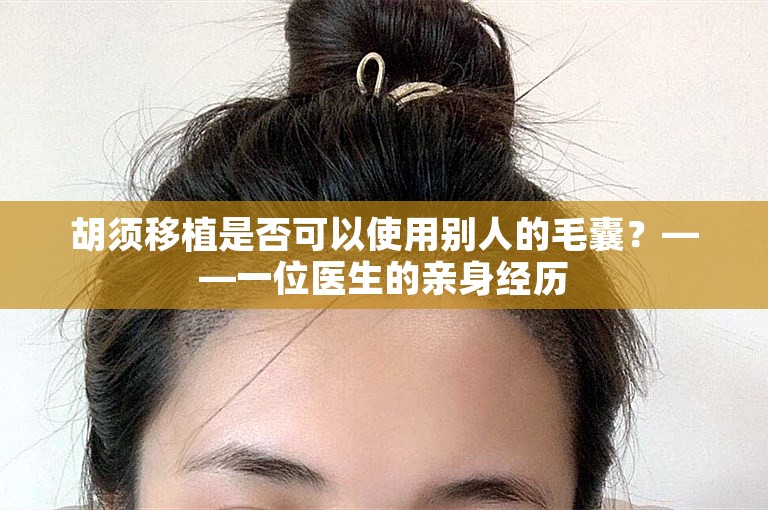 胡须移植是否可以使用别人的毛囊？——一位医生的亲身经历