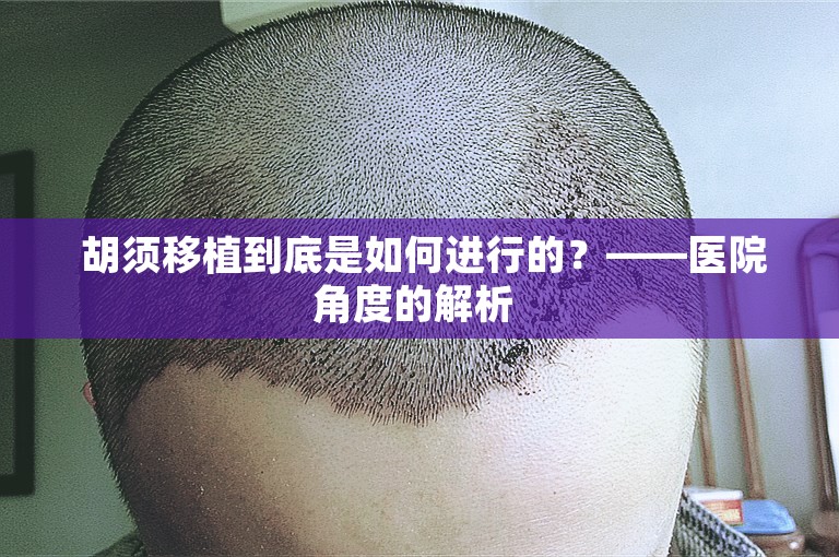  胡须移植到底是如何进行的？——医院角度的解析 